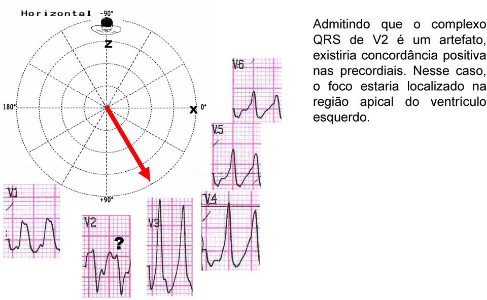 precordiais.