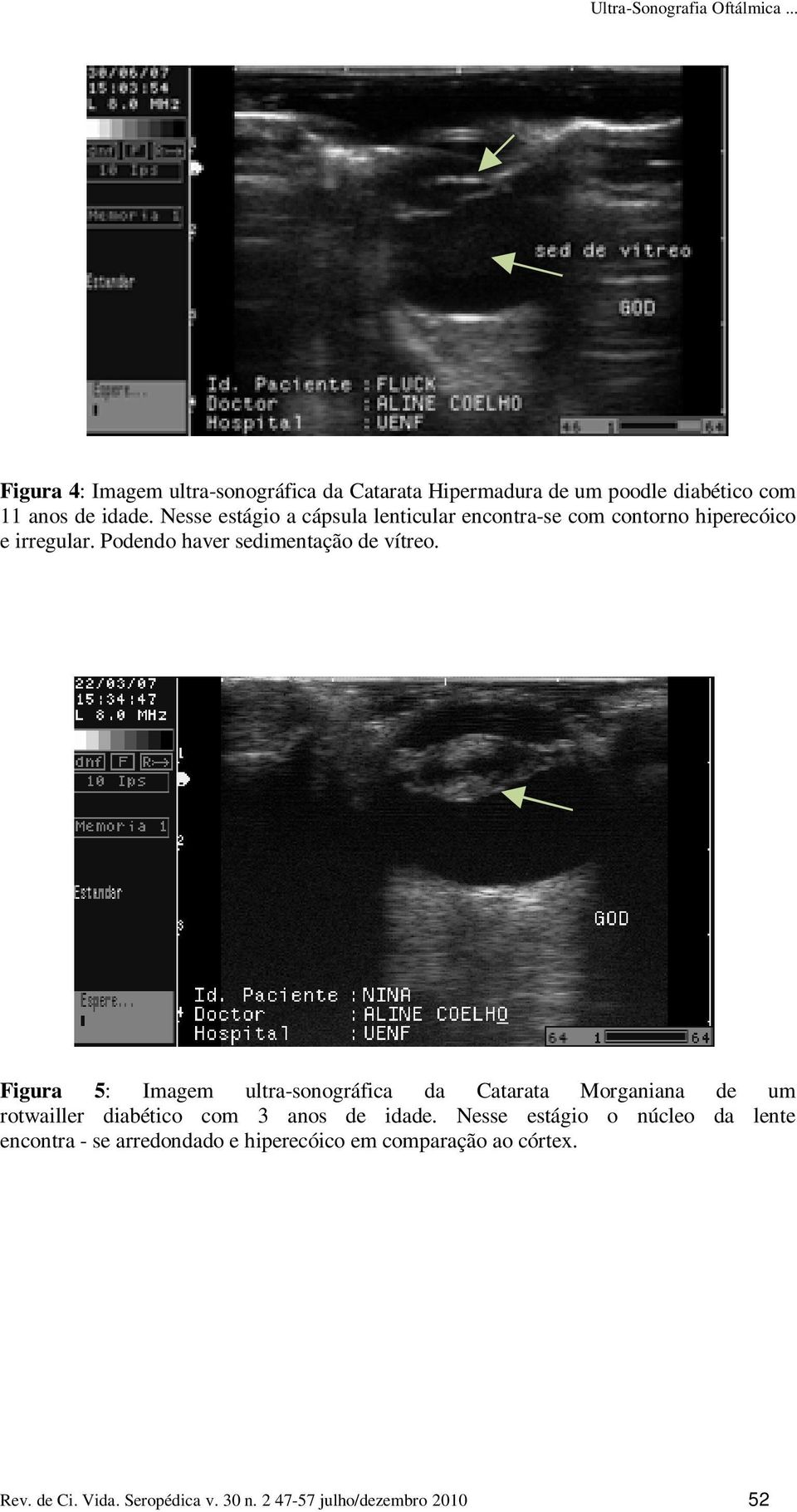 Figura 5: Imagem ultra-sonográfica da Catarata Morganiana de um rotwailler diabético com 3 anos de idade.