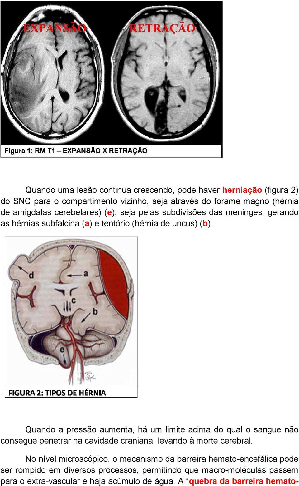 Quando a pressão aumenta, há um limite acima do qual o sangue não consegue penetrar na cavidade craniana, levando à morte cerebral.