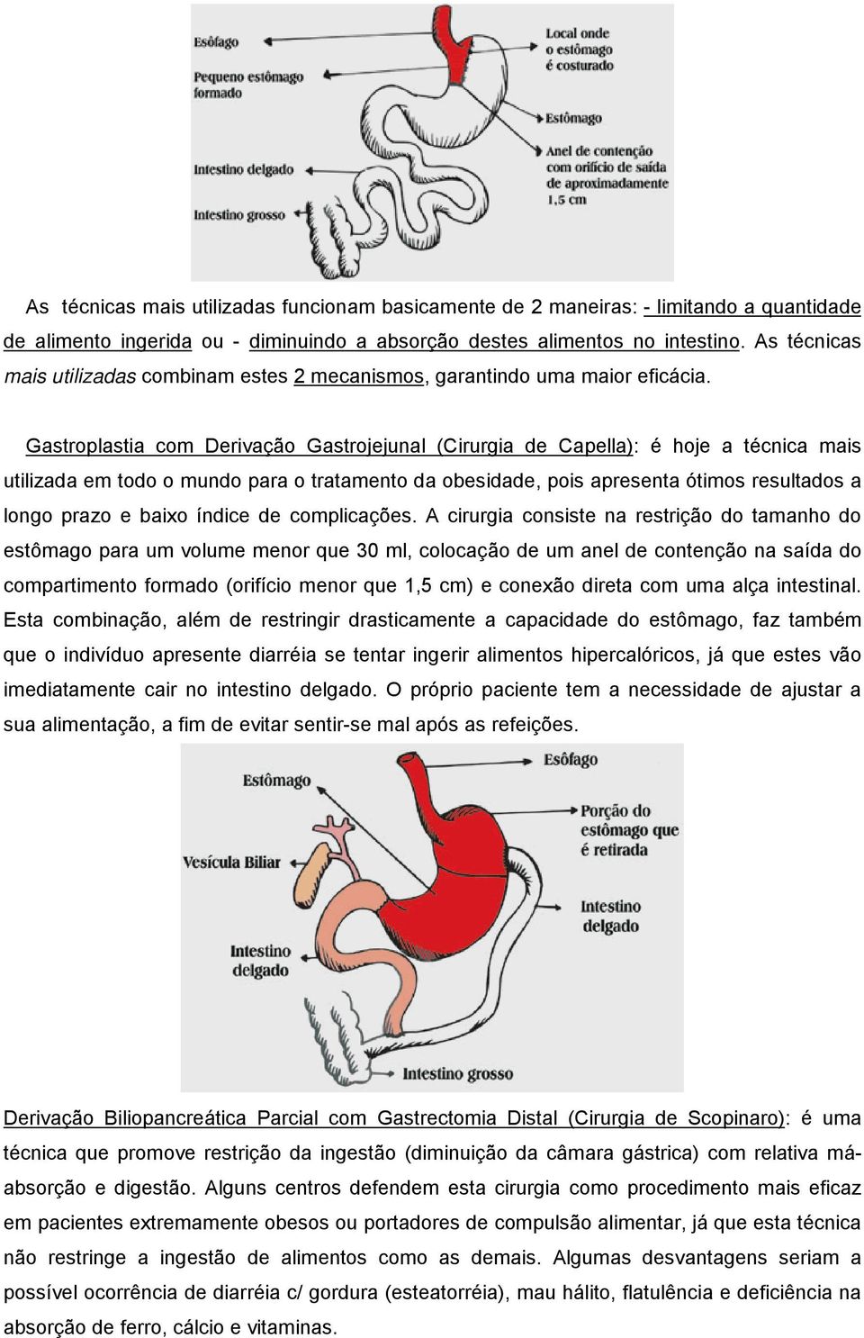 Gastroplastia com Derivação Gastrojejunal (Cirurgia de Capella): é hoje a técnica mais utilizada em todo o mundo para o tratamento da obesidade, pois apresenta ótimos resultados a longo prazo e baixo