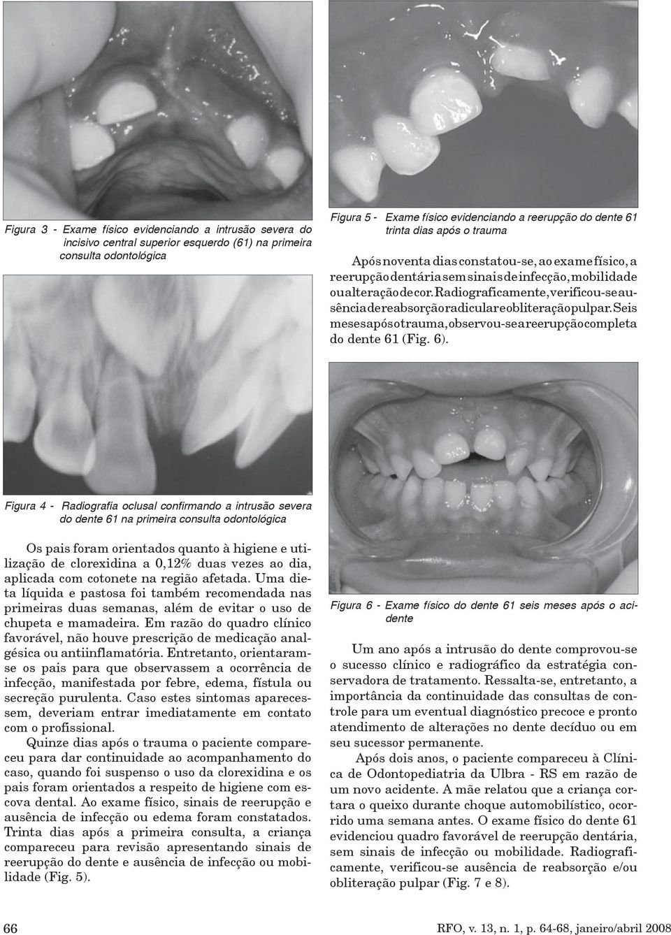 Radiograficamente, verificou-se ausência de reabsorção radicular e obliteração pulpar. Seis meses após o trauma, observou-se a reerupção completa do dente 61 (Fig. 6).