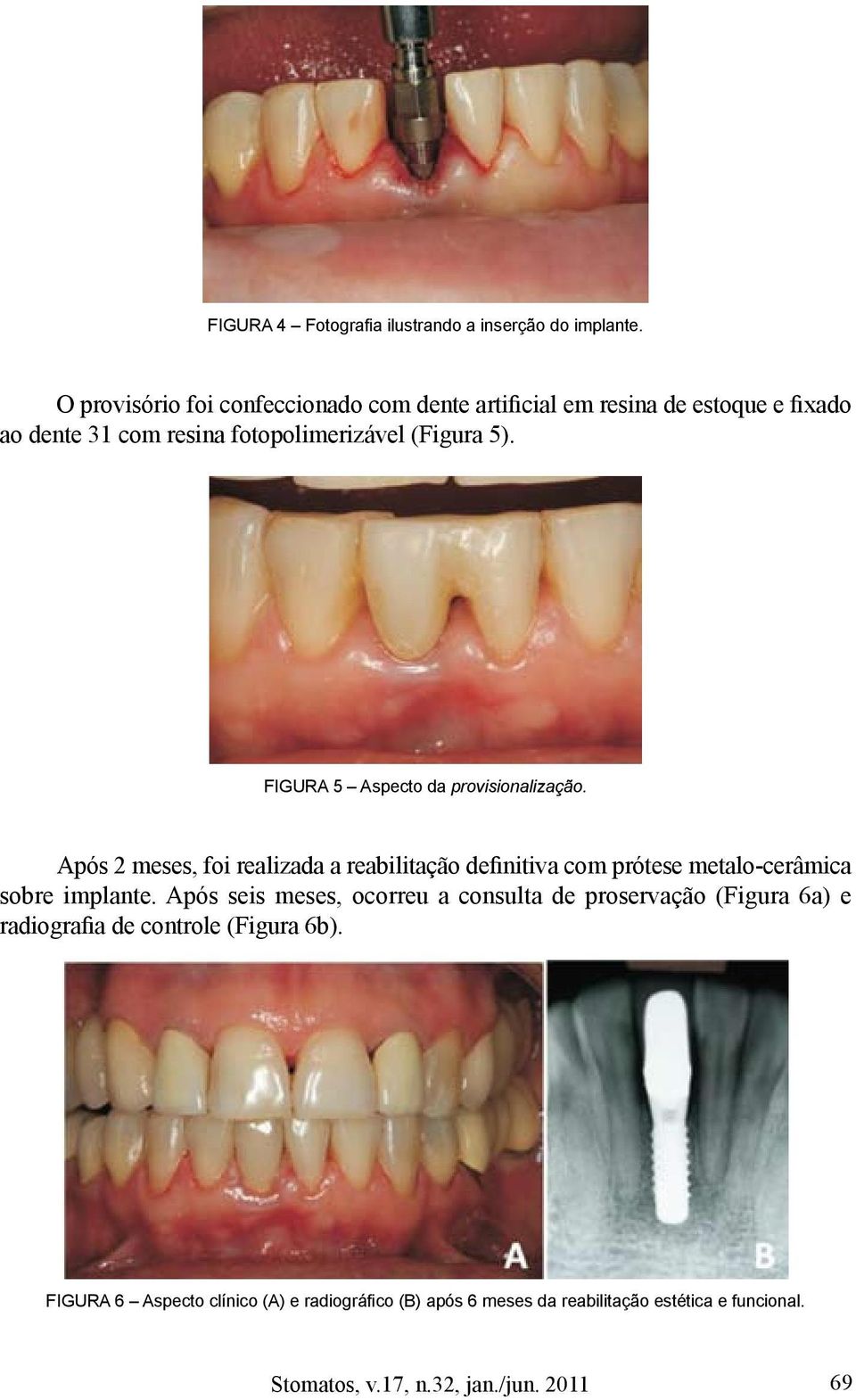 5). FIGURA 5 Aspecto da provisionalização.