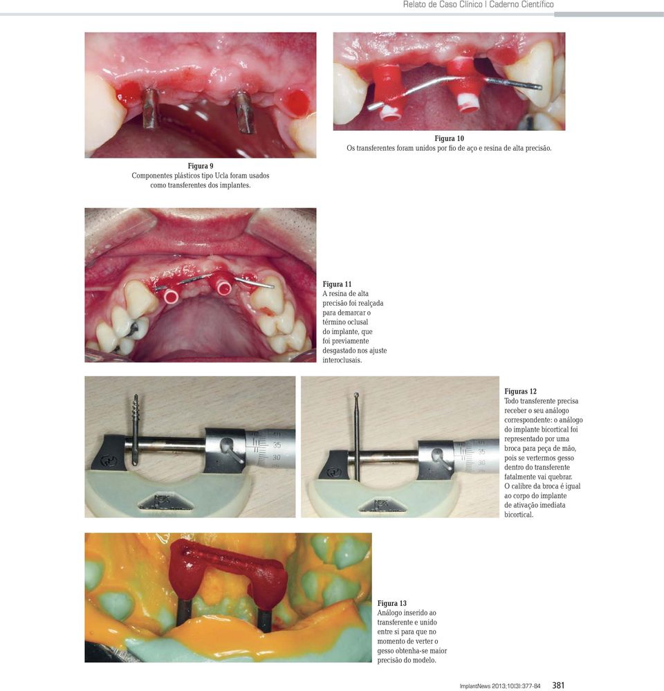 Figura 11 A resina de alta precisão foi realçada para demarcar o término oclusal do implante, que foi previamente desgastado nos ajuste interoclusais.