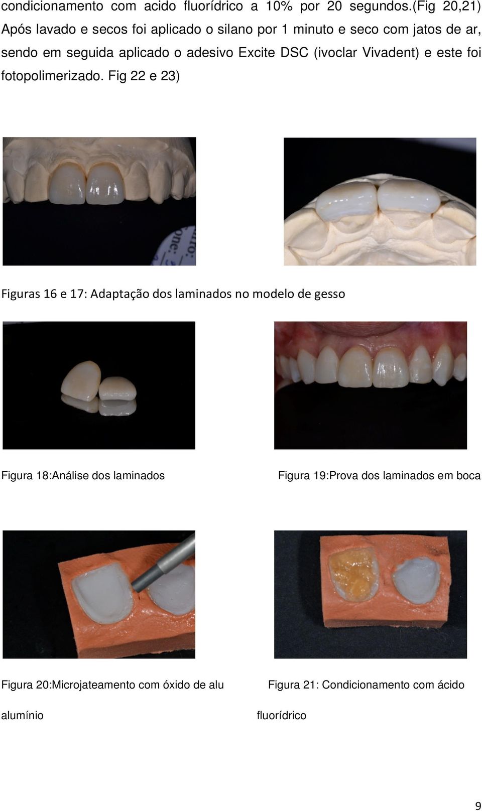 adesivo Excite DSC (ivoclar Vivadent) e este foi fotopolimerizado.