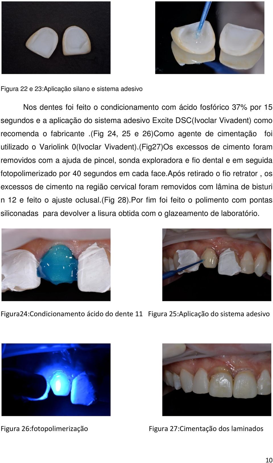 (Fig27)Os excessos de cimento foram removidos com a ajuda de pincel, sonda exploradora e fio dental e em seguida fotopolimerizado por 40 segundos em cada face.