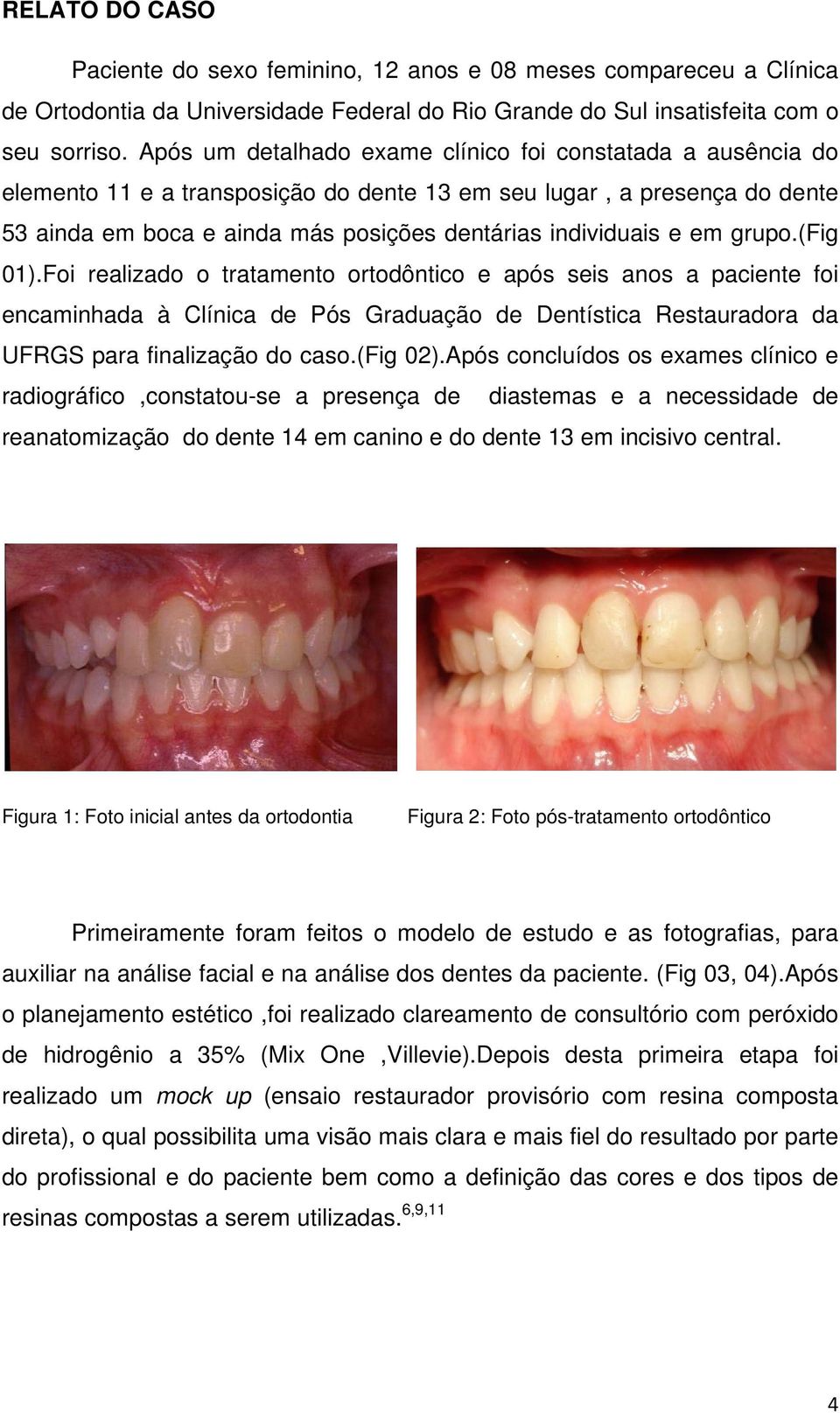 em grupo.(fig 01).Foi realizado o tratamento ortodôntico e após seis anos a paciente foi encaminhada à Clínica de Pós Graduação de Dentística Restauradora da UFRGS para finalização do caso.(fig 02).