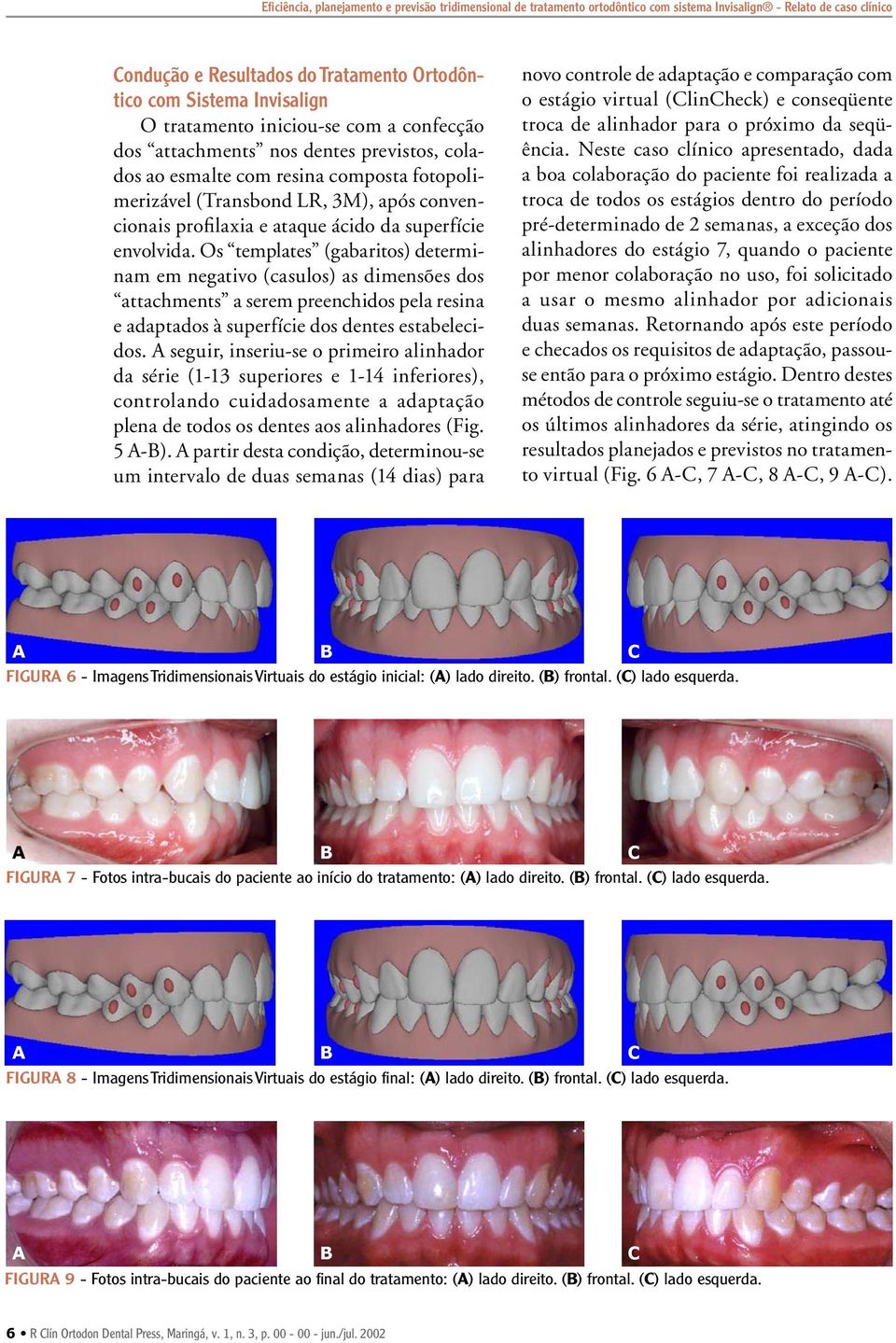 da superfície envolvida. Os templates (gabaritos) determinam em negativo (casulos) as dimensões dos attachments a serem preenchidos pela resina e adaptados à superfície dos dentes estabelecidos.