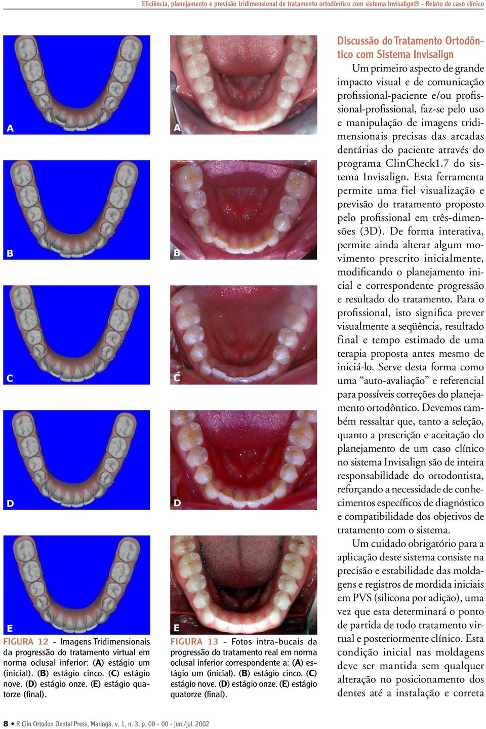 C D E FIGUR 13 - Fotos intra-bucais da progressão do tratamento real em norma oclusal inferior correspondente a: () estágio um (inicial). () estágio cinco. (C) estágio nove. (D) estágio onze.