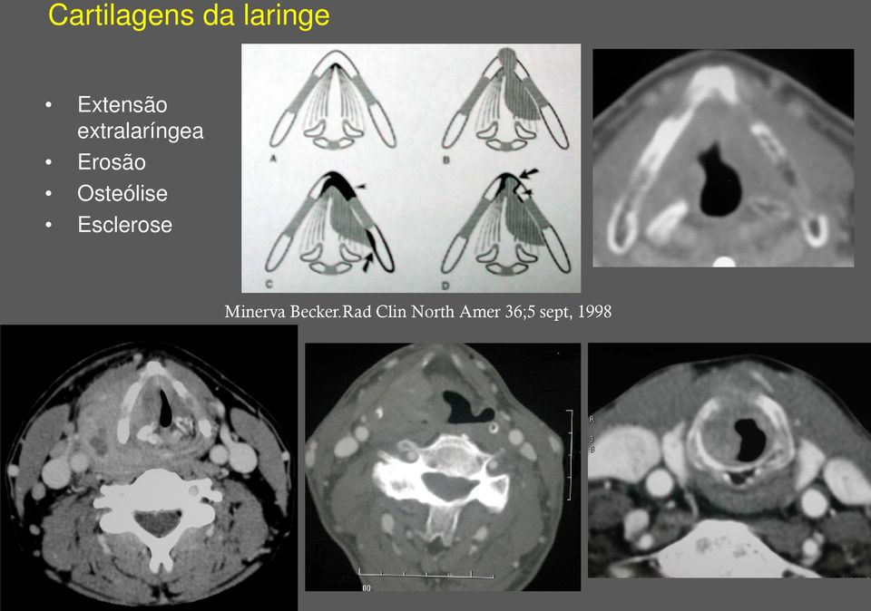 Osteólise Esclerose Minerva