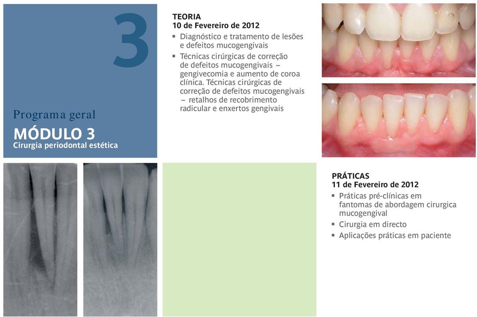 Técnicas cirúrgicas de correção de defeitos mucogengivais retalhos de recobrimento radicular e enxertos gengivais PRÁTICAS 11 de