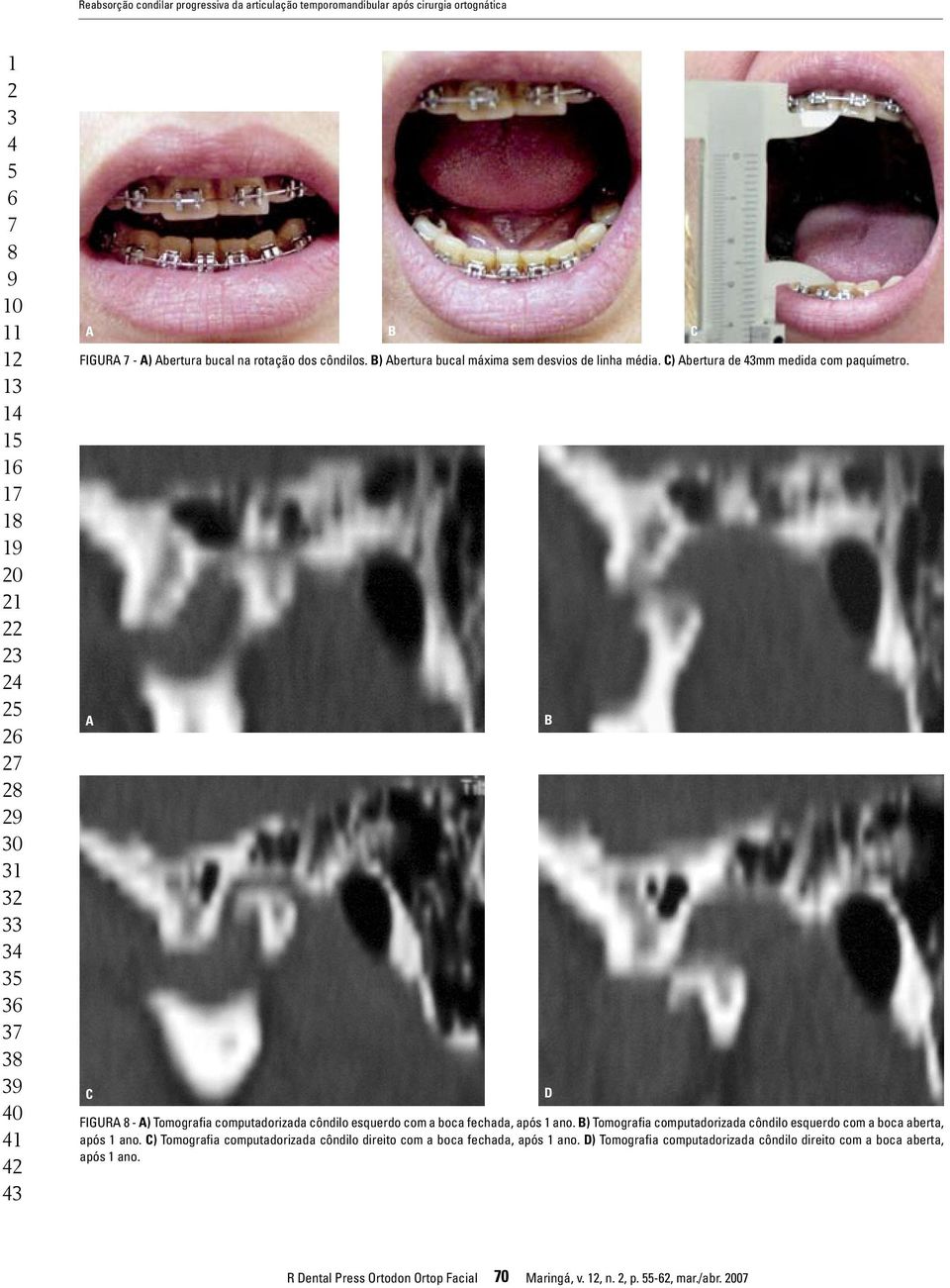 A C Figura 8 - A) Tomografia computadorizada côndilo esquerdo com a boca fechada, após 1 ano. B) Tomografia computadorizada côndilo esquerdo com a boca aberta, após 1 ano.