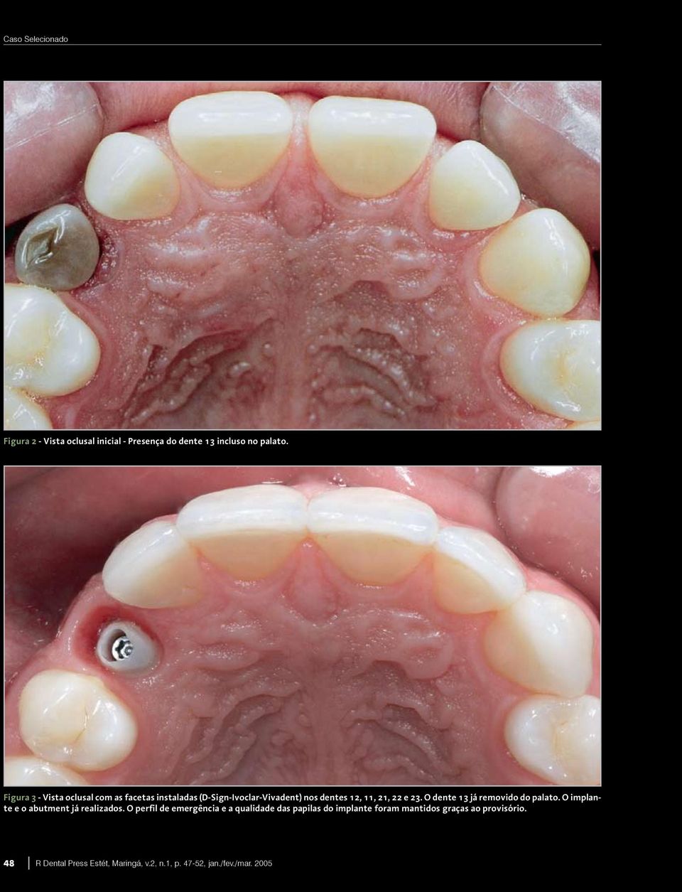 23. O dente 13 já removido do palato. O implante e o abutment já realizados.