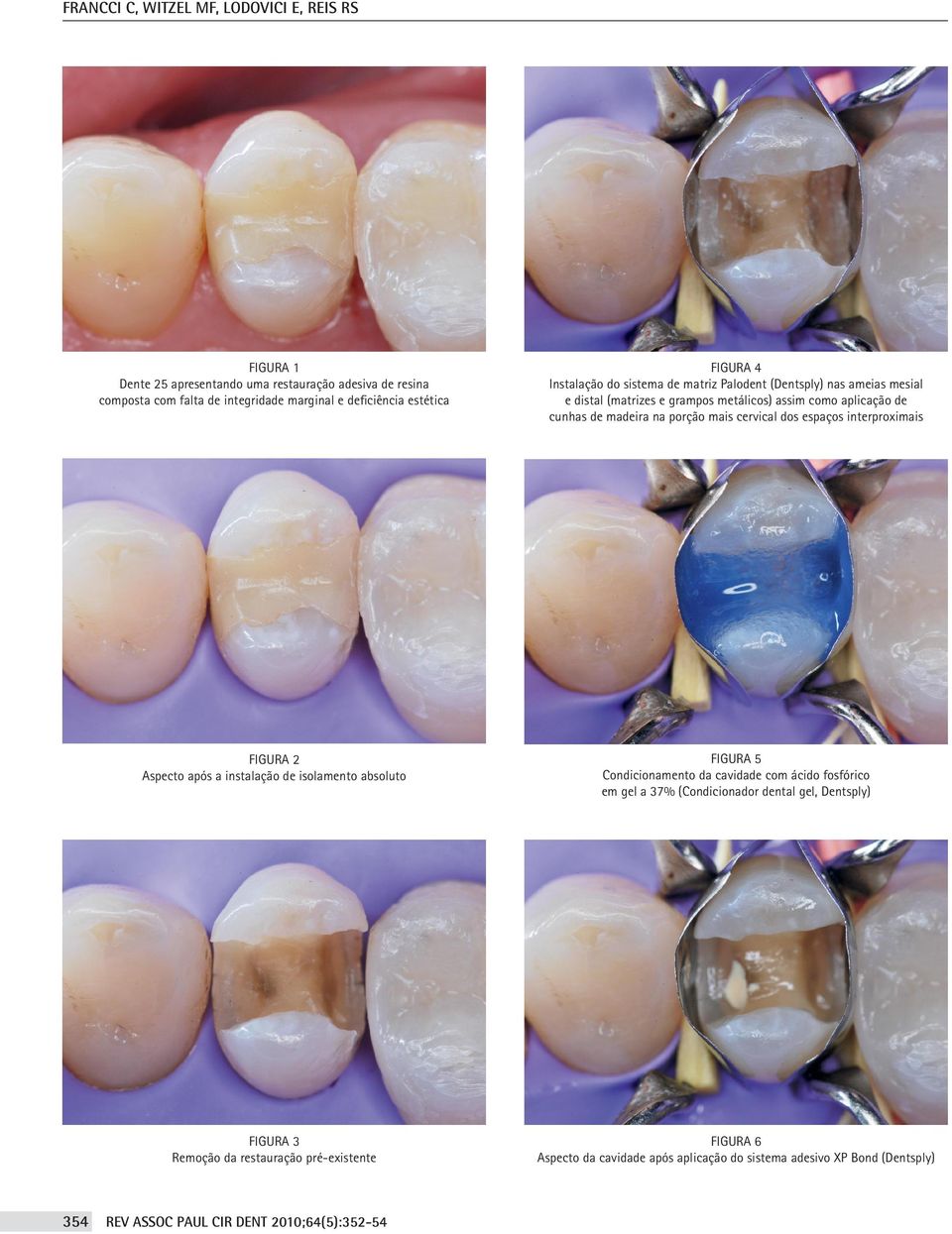 na porção mais cervical dos espaços interproximais Figura 2 Aspecto após a instalação de isolamento absoluto Figura 5 Condicionamento da cavidade com ácido fosfórico em