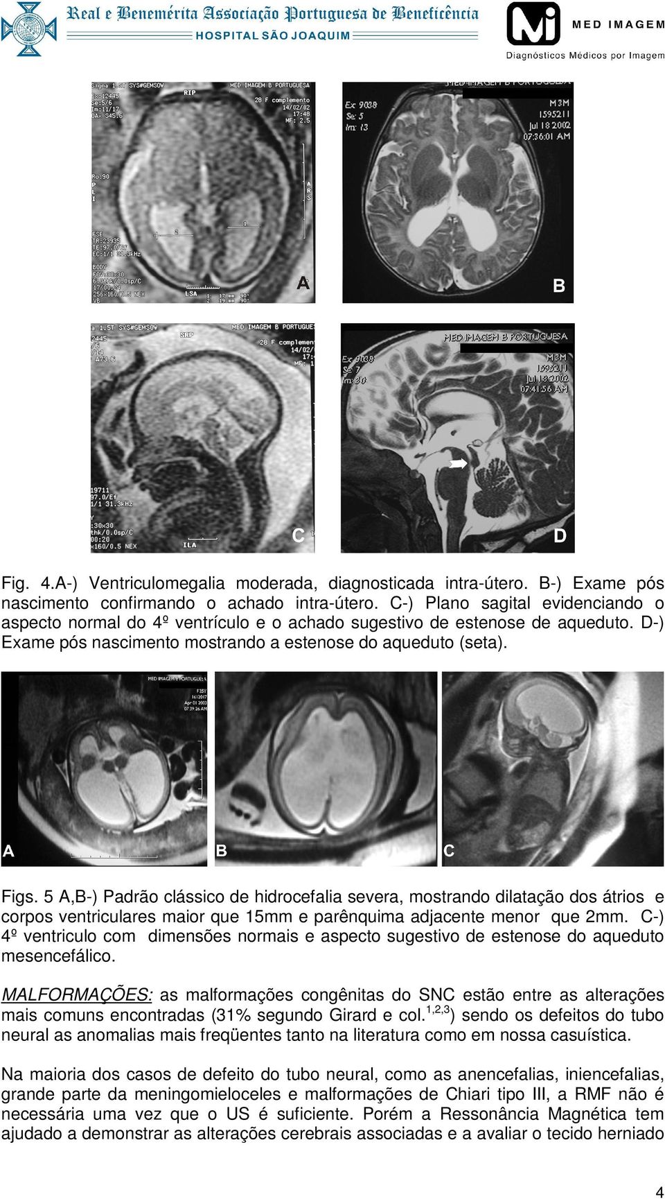 5 A,B-) Padrão clássico de hidrocefalia severa, mostrando dilatação dos átrios e corpos ventriculares maior que 15mm e parênquima adjacente menor que 2mm.