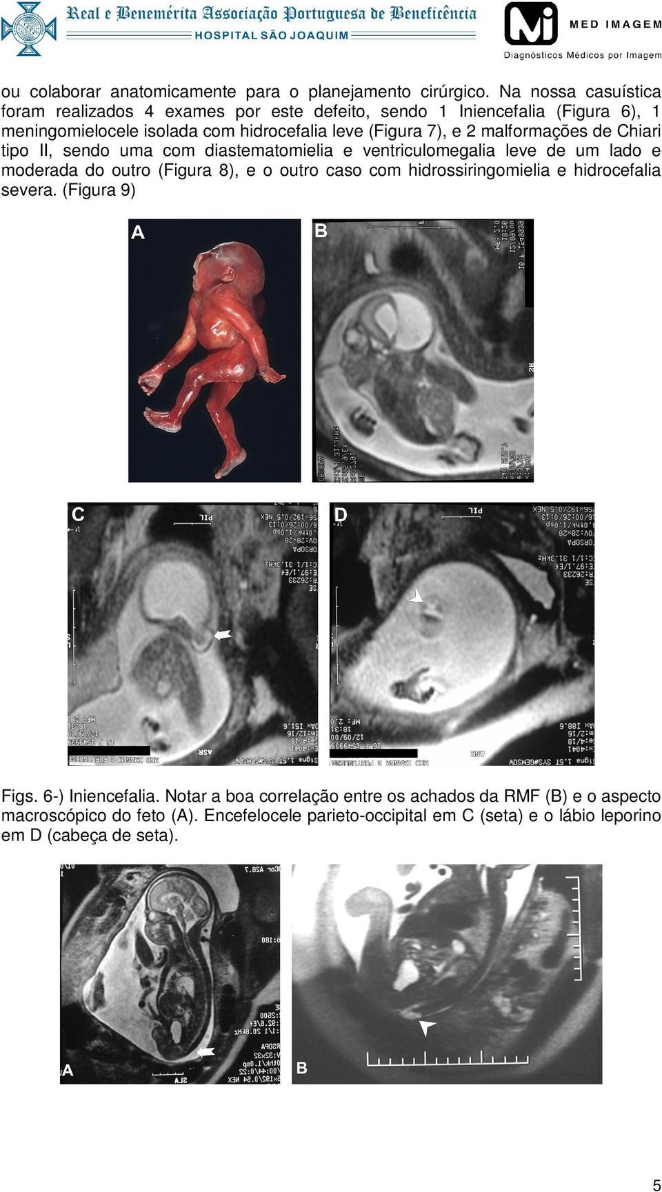 7), e 2 malformações de Chiari tipo II, sendo uma com diastematomielia e ventriculomegalia leve de um lado e moderada do outro (Figura 8), e o outro caso