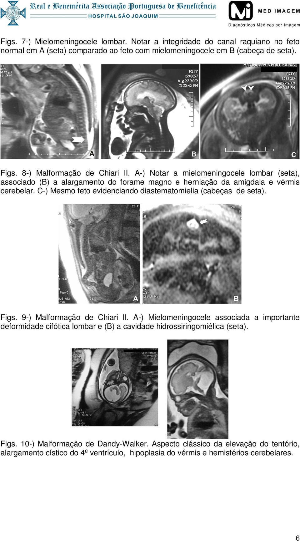 C-) Mesmo feto evidenciando diastematomielia (cabeças de seta). Figs. 9-) Malformação de Chiari II.
