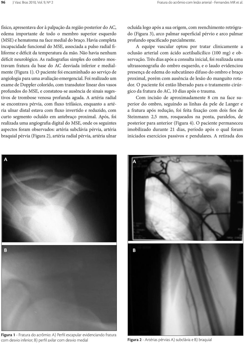 Havia completa incapacidade funcional do MSE, associada a pulso radial filiforme e déficit da temperatura da mão. Não havia nenhum déficit neurológico.