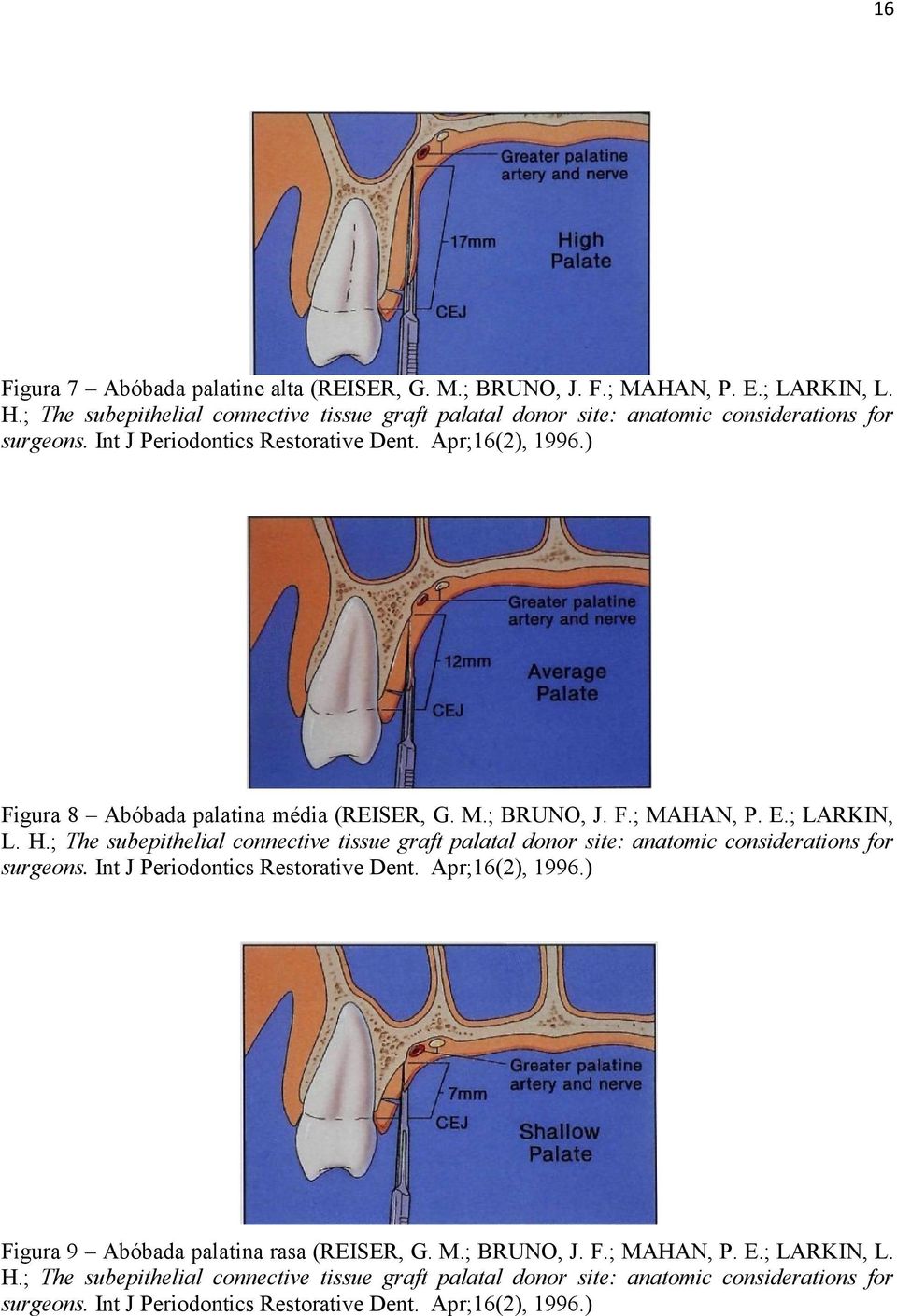 ) Figura 8 Abóbada palatina média (REISER, G. M.; BRUNO, J. F.; MAHAN, P. E.; LARKIN, L. H.) Figura 9 Abóbada palatina rasa (REISER, G. M.; BRUNO, J. F.; MAHAN, P. E.; LARKIN, L. H.)