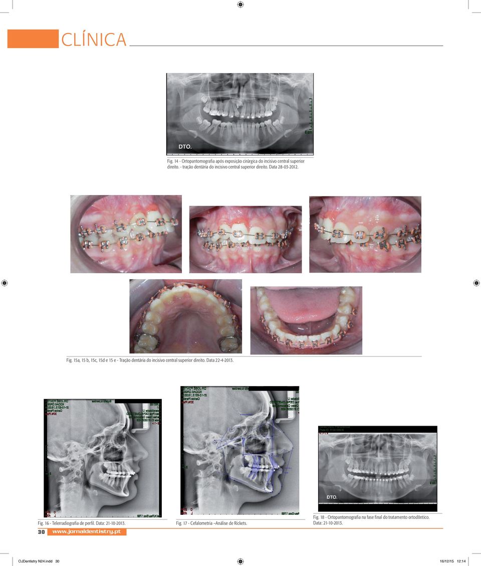 15a, 15 b, 15c, 15d e 15 e - Tração dentária do incisivo central superior direito. Data 22-4-2013. Fig.