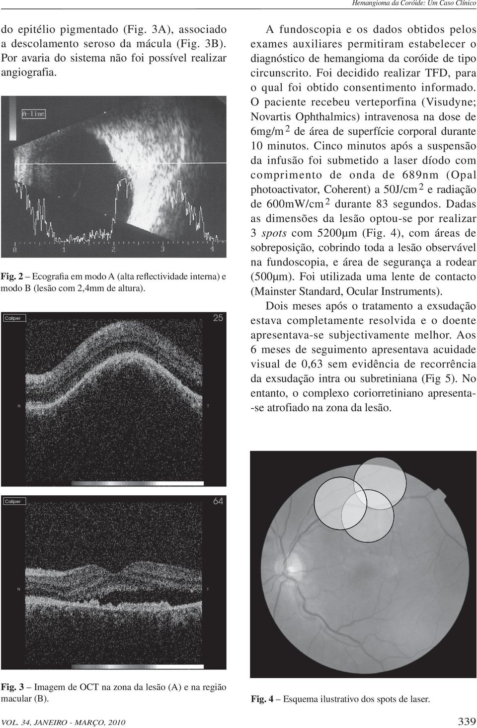 A fundoscopia e os dados obtidos pelos exames auxiliares permitiram estabelecer o diagnóstico de hemangioma da coróide de tipo circunscrito.