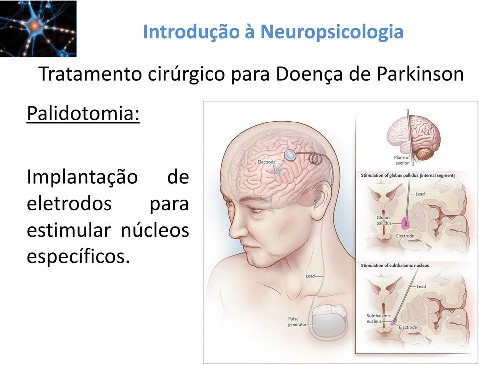 Palidotomia: Implantação de