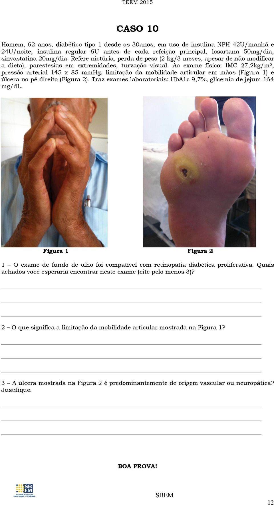 Ao exame físico: IMC 27,2kg/m 2, pressão arterial 145 x 85 mmhg, limitação da mobilidade articular em mãos (Figura 1) e úlcera no pé direito (Figura 2).