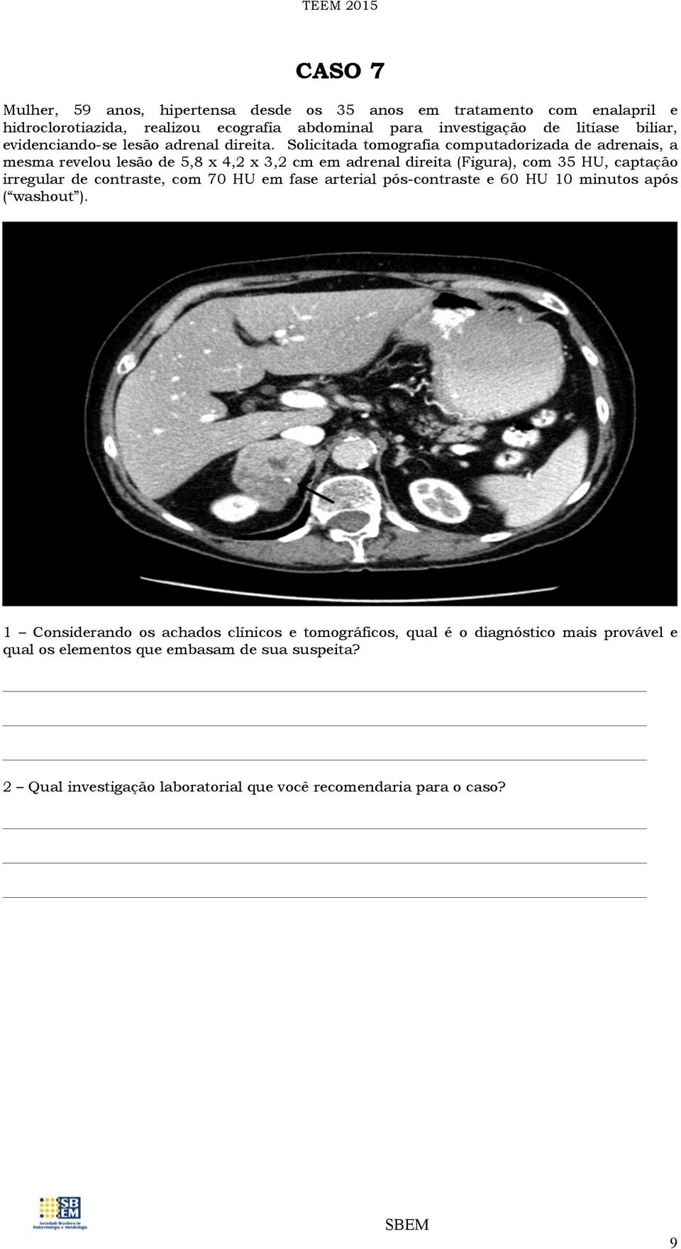 Solicitada tomografia computadorizada de adrenais, a mesma revelou lesão de 5,8 x 4,2 x 3,2 cm em adrenal direita (Figura), com 35 HU, captação irregular de