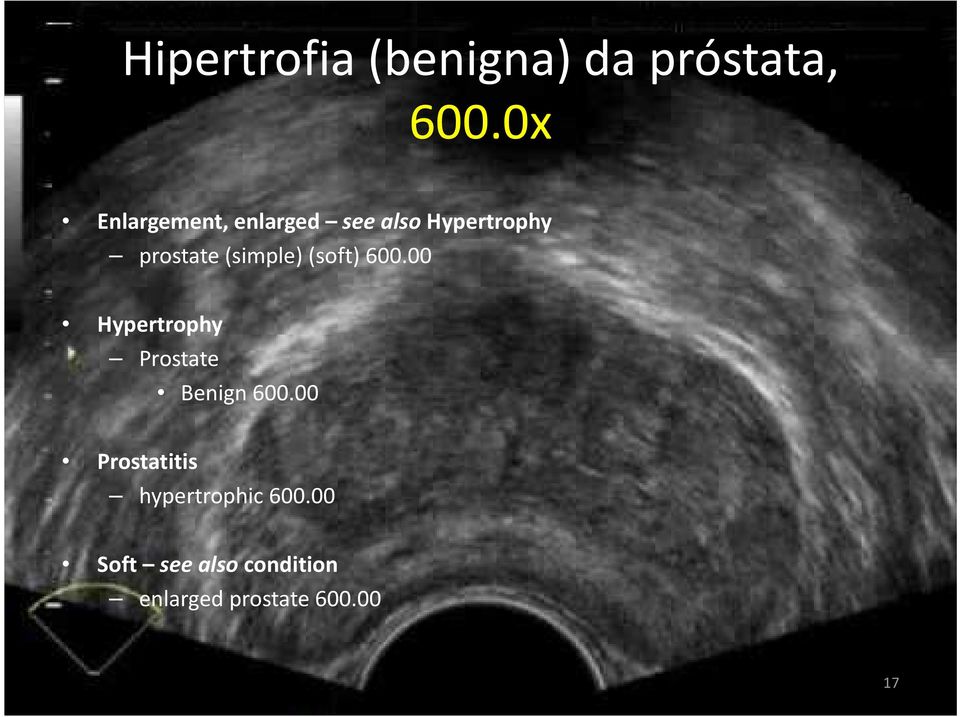 (simple) (soft) 600.00 Hypertrophy Prostate Benign 600.