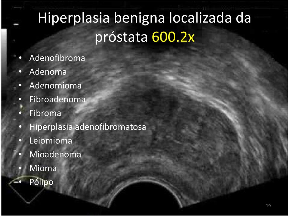 Fibroadenoma Fibroma próstata 600.