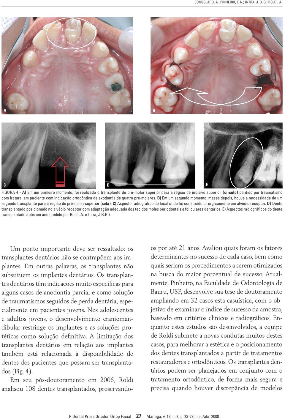 indicação ortodôntica de exodontia de quatro pré-molares. B) Em um segundo momento, meses depois, houve a necessidade de um segundo transplante para a região de pré-molar superior (seta).