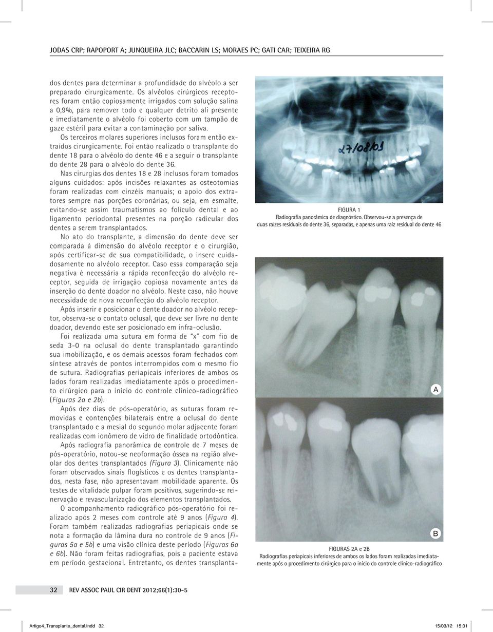 de gaze estéril para evitar a contaminação por saliva. Os terceiros molares superiores inclusos foram então extraídos cirurgicamente.