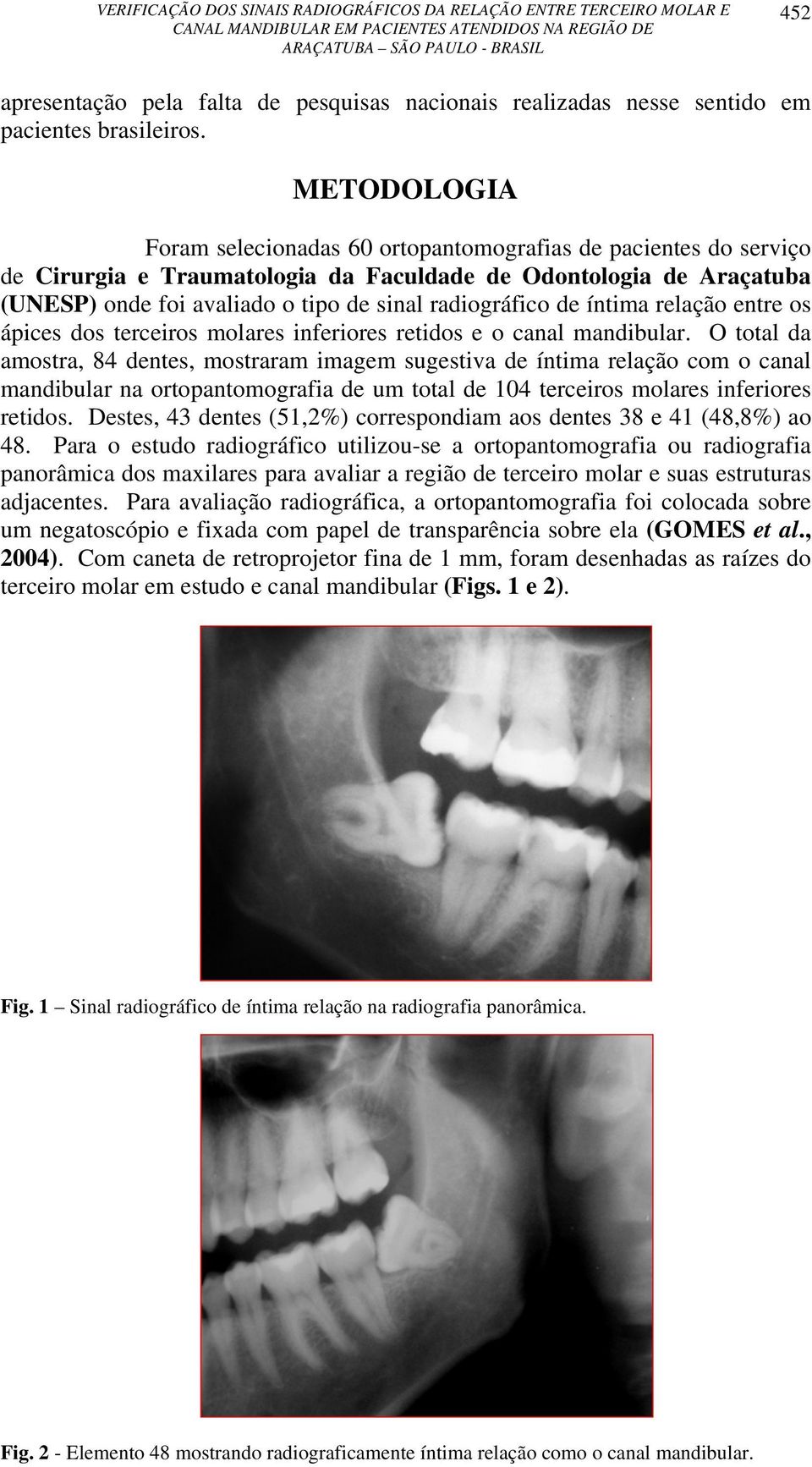 radiográfico de íntima relação entre os ápices dos terceiros molares inferiores retidos e o canal mandibular.