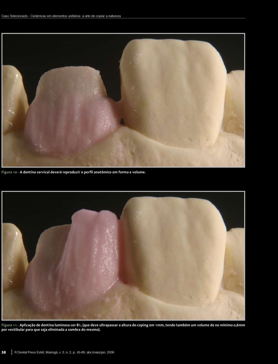 Figura 11 - Aplicação de dentina luminosa cor B1, (que deve ultrapassar a altura do coping