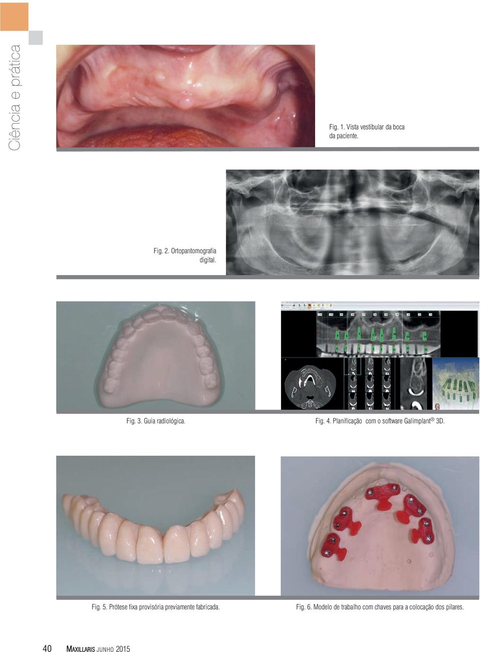 Planificação com o software Galimplant 3D. Fig. 5.