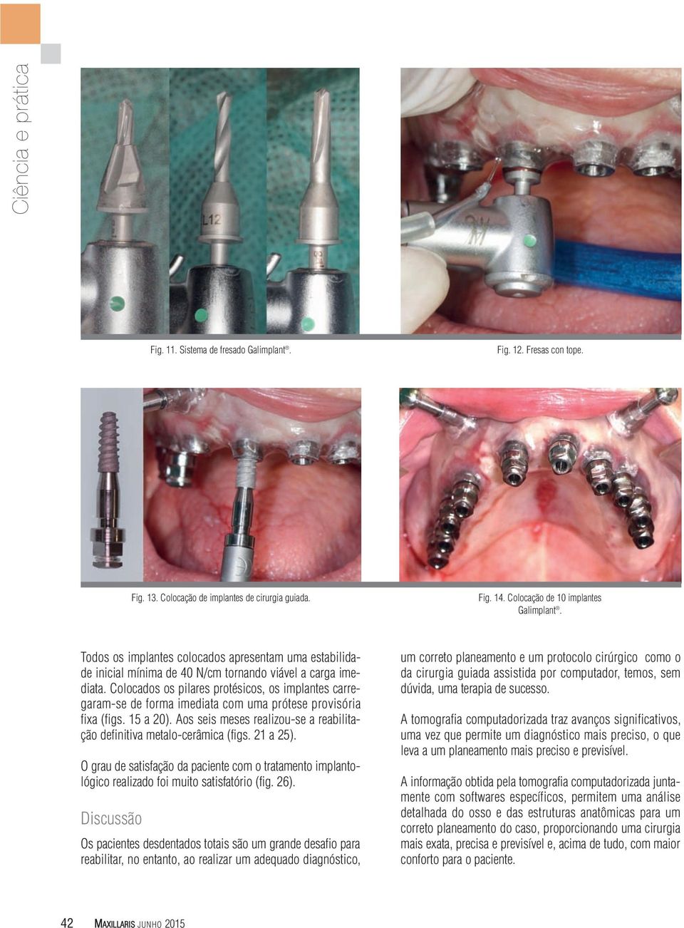 Colocados os pilares protésicos, os implantes carregaram-se de forma imediata com uma prótese provisória fixa (figs. 15 a 20).