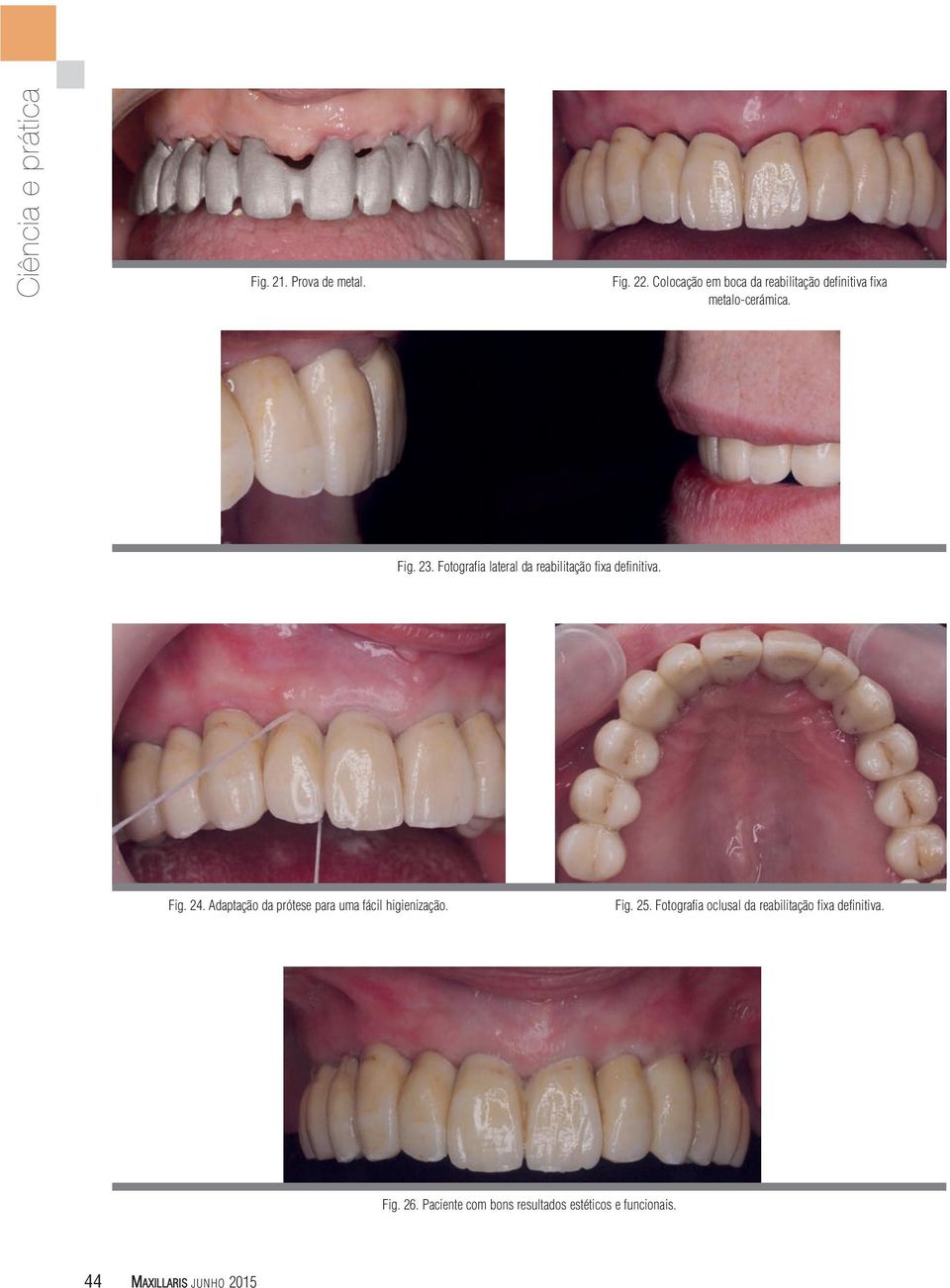 Fotografia lateral da reabilitação fixa definitiva. Fig. 24.
