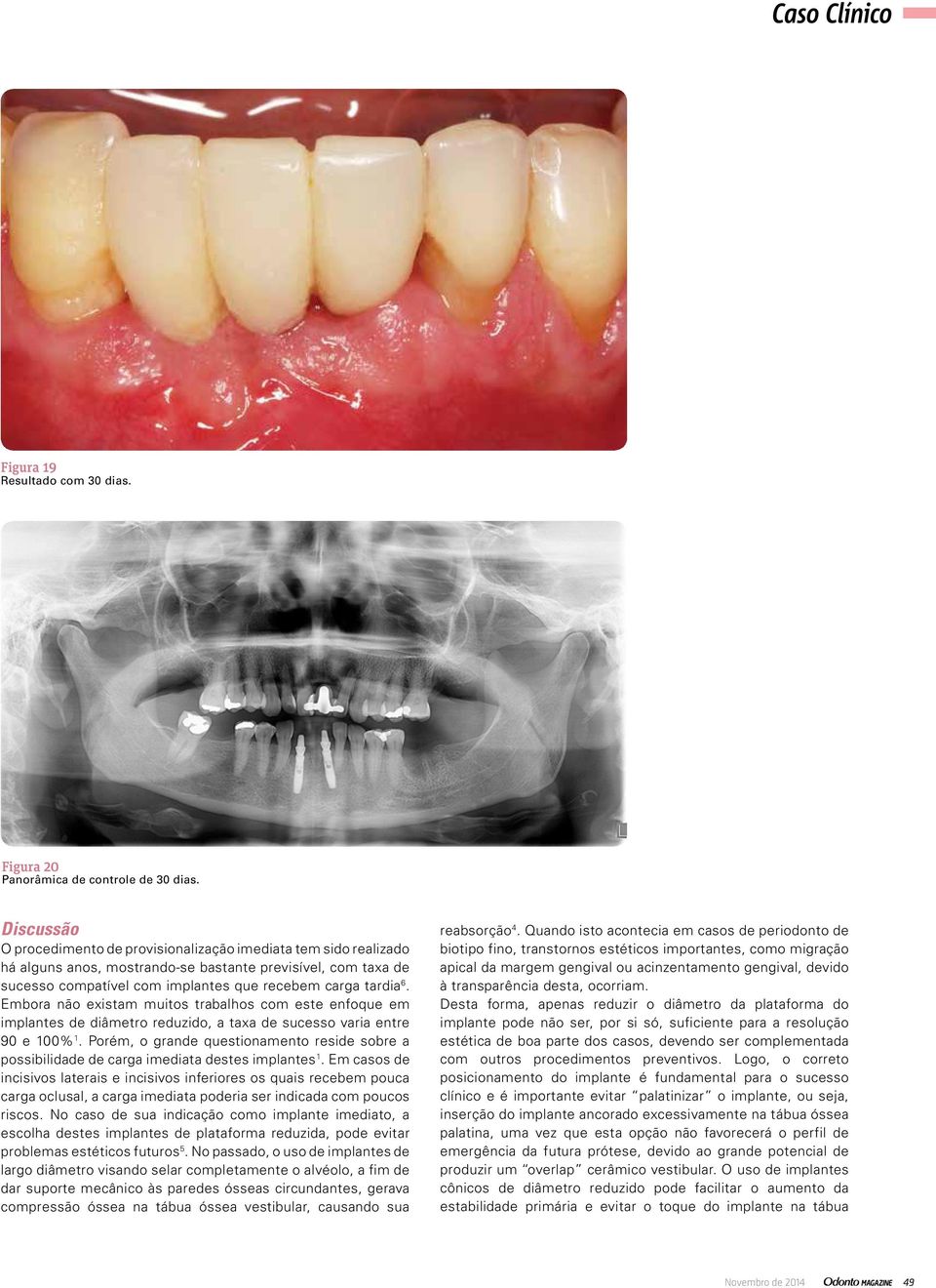 Embora não existam muitos trabalhos com este enfoque em implantes de diâmetro reduzido, a taxa de sucesso varia entre 90 e 100% 1.