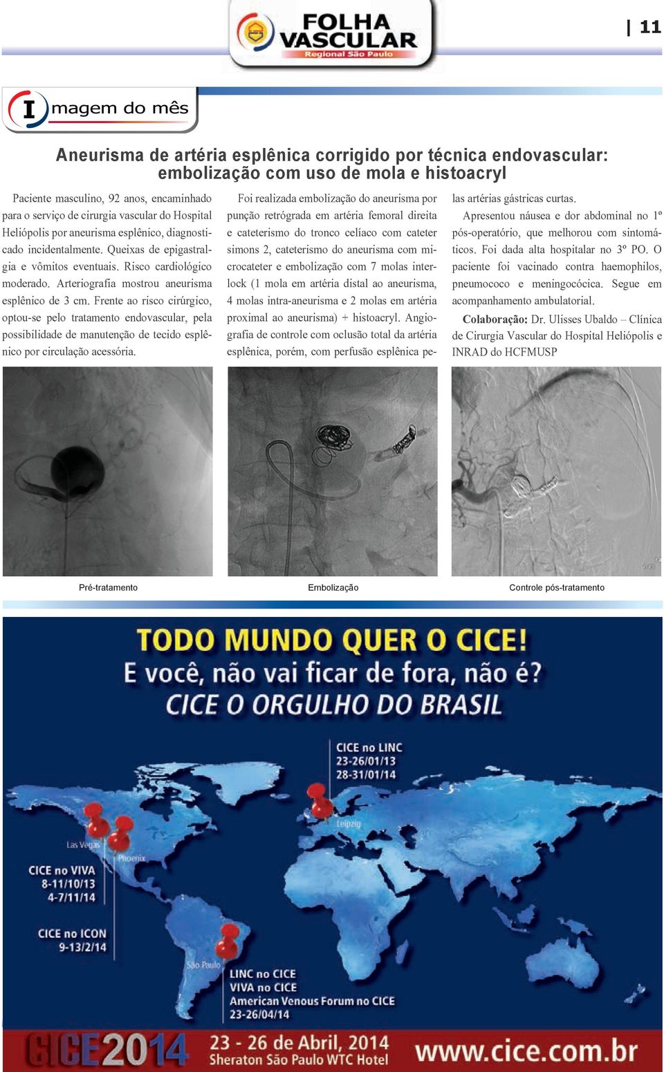 Arteriografia mostrou aneurisma esplênico de 3 cm. Frente ao risco cirúrgico, optou-se pelo tratamento endovascular, pela possibilidade de manutenção de tecido esplênico por circulação acessória.