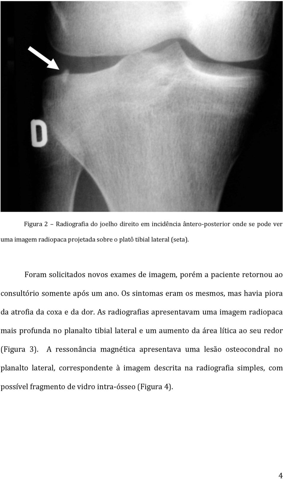 Os sintomas eram os mesmos, mas havia piora da atrofia da coxa e da dor.