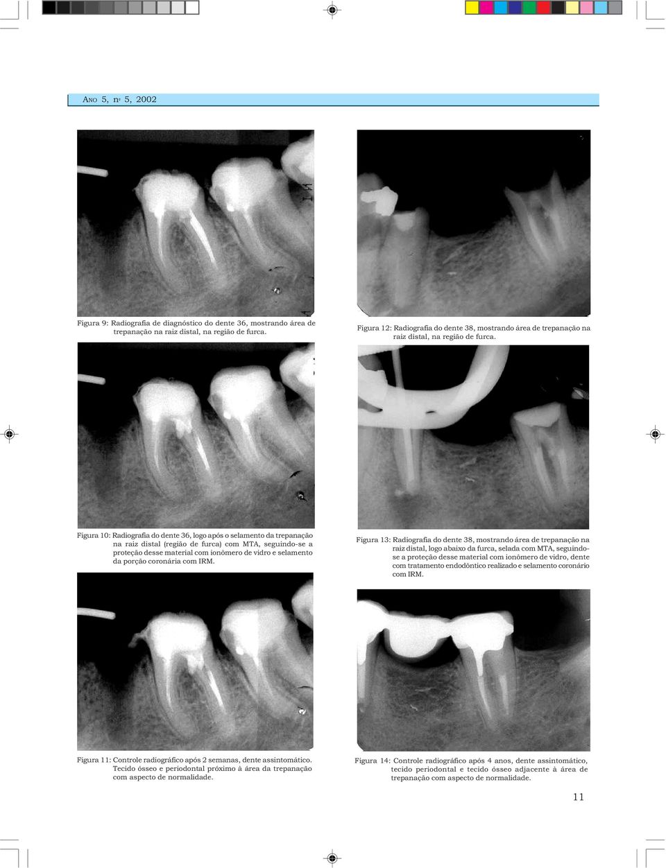 Figura 10: Radiografia do dente 36, logo após o selamento da trepanação na raiz distal (região de furca) com MTA, seguindo-se a proteção desse material com ionômero de vidro e selamento da porção