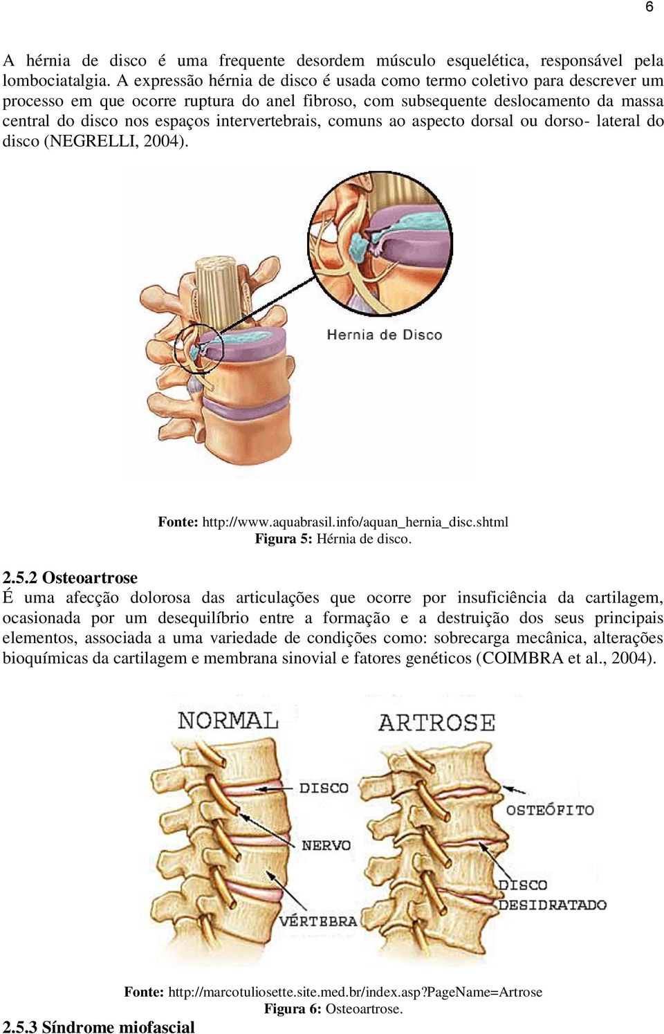 intervertebrais, comuns ao aspecto dorsal ou dorso- lateral do disco (NEGRELLI, 2004). Fonte: http://www.aquabrasil.info/aquan_hernia_disc.shtml Figura 5: