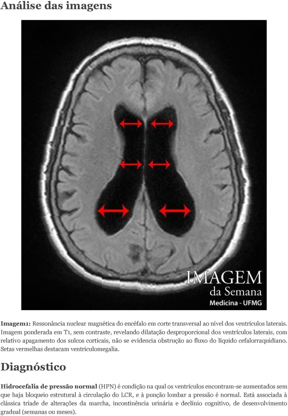 do líquido cefalorraquidiano. Setas vermelhas destacam ventriculomegalia.