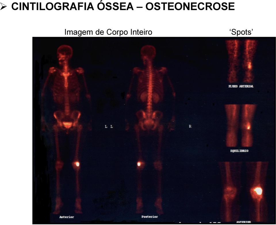 OSTEONECROSE