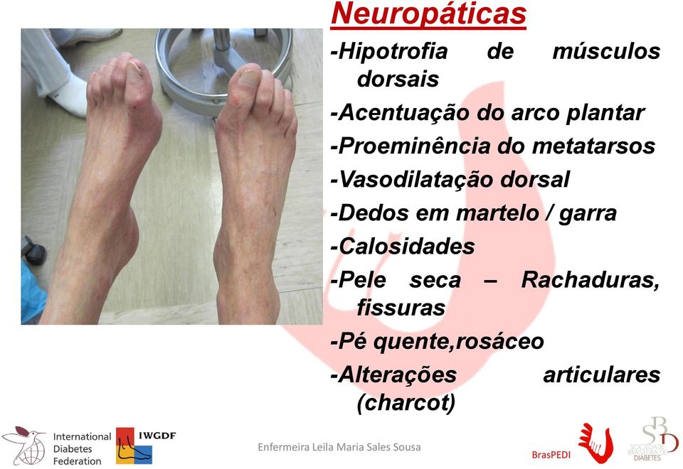 martelo / garra -Calosidades -Pele seca Rachaduras, fissuras -Pé