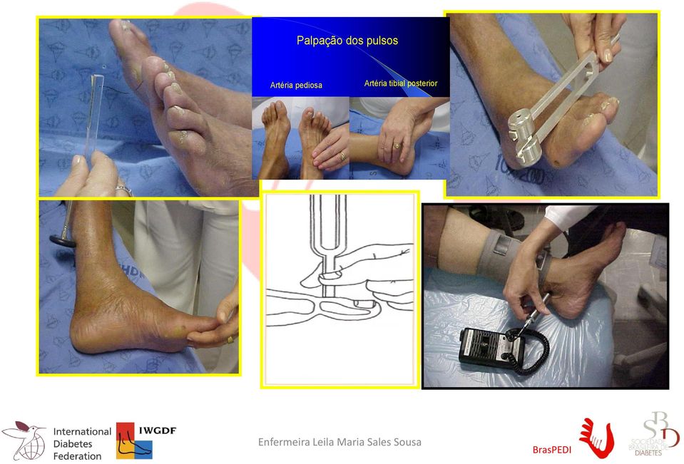 tibial posterior