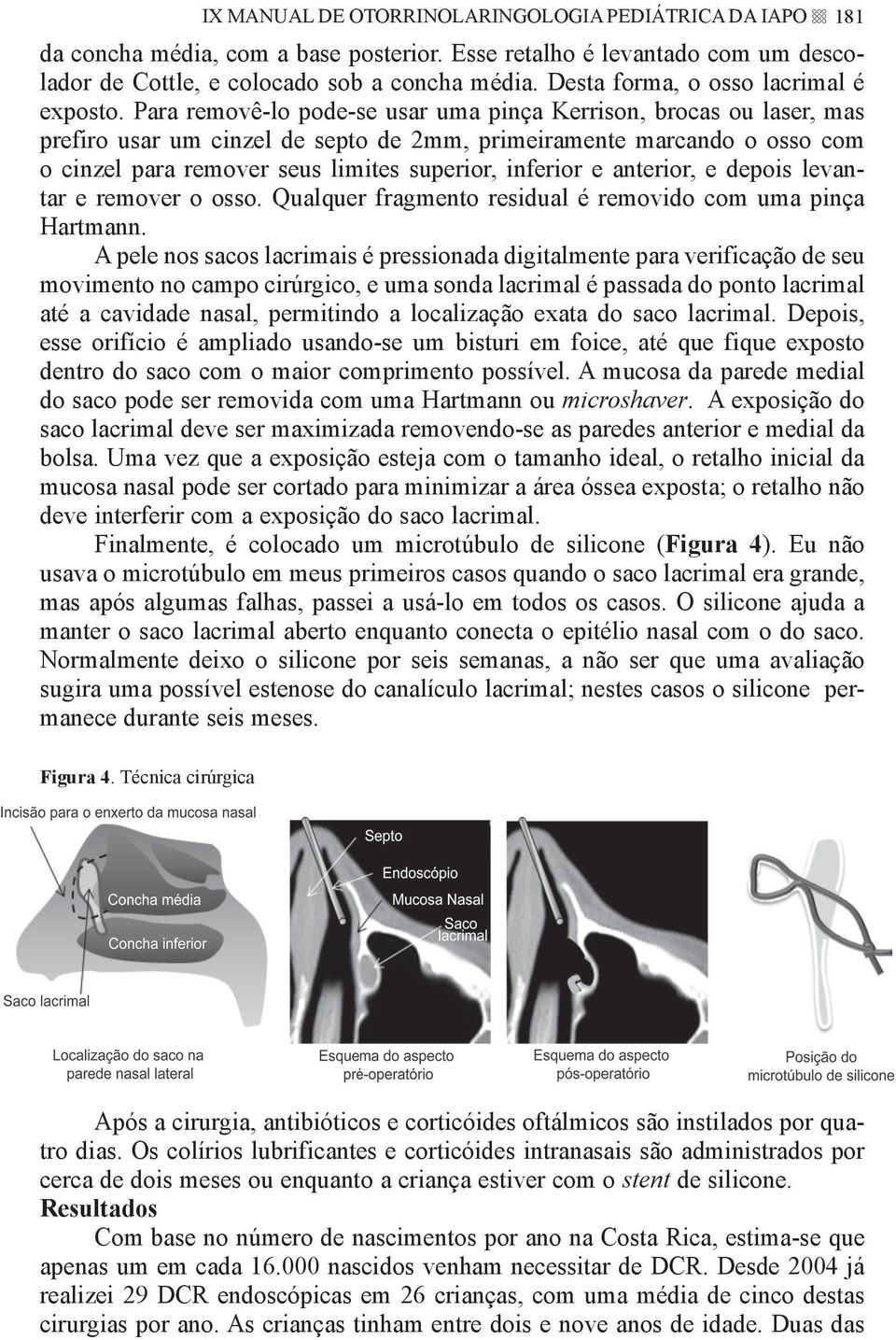 Para removê-lo pode-se usar uma pinça Kerrison, brocas ou laser, mas prefiro usar um cinzel de septo de 2mm, primeiramente marcando o osso com o cinzel para remover seus limites superior, inferior e