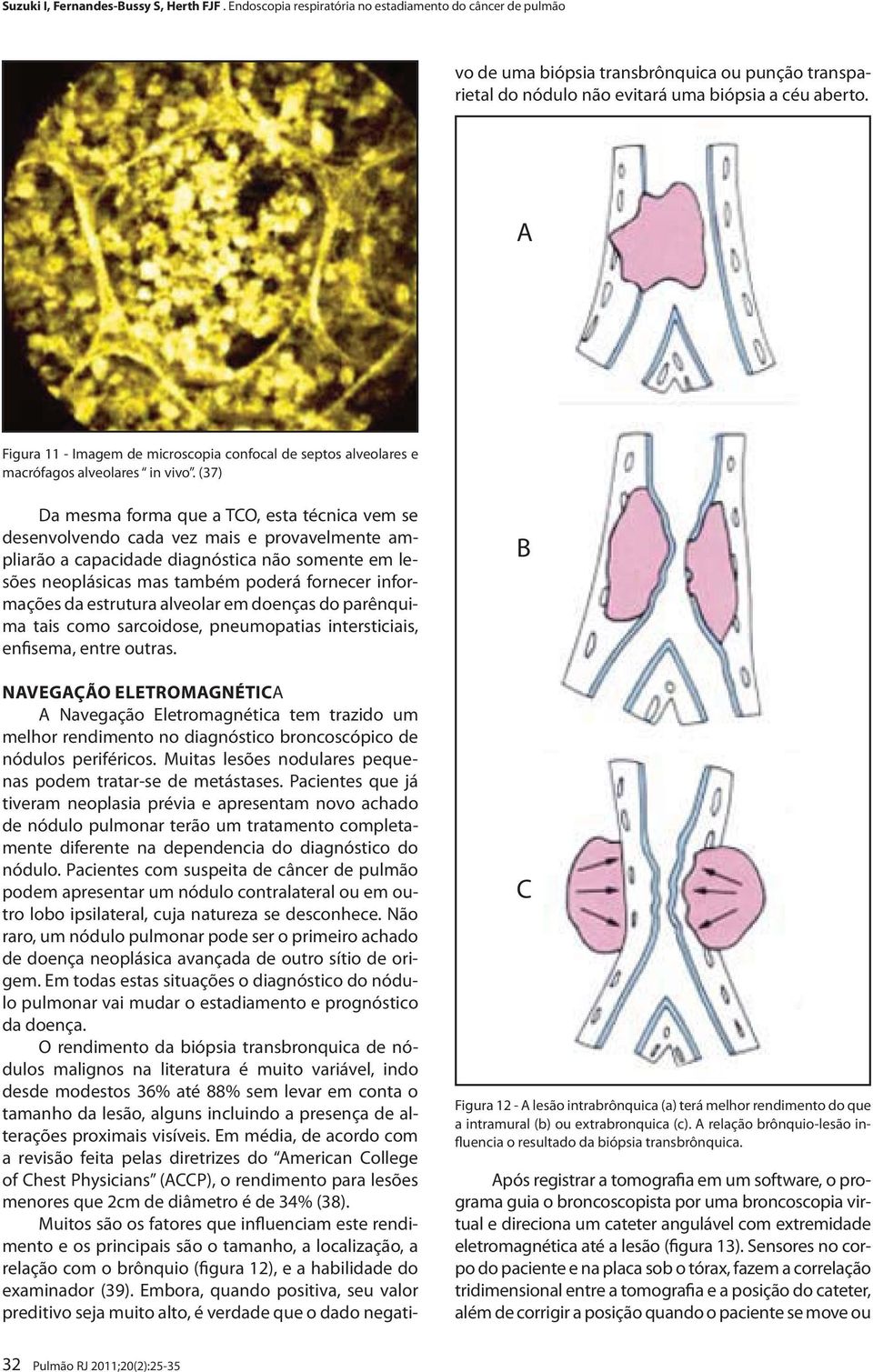 Pacientes que já tiveram neoplasia prévia e apresentam novo achado de nódulo pulmonar terão um tratamento completamente diferente na dependencia do diagnóstico do nódulo.