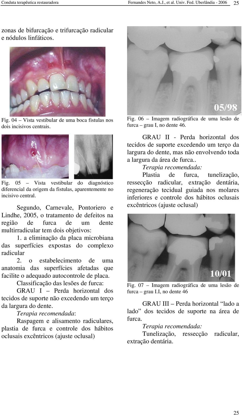 Segundo, Carnevale, Pontoriero e Lindhe, 2005, o tratamento de defeitos na região de furca de um dente multirradicular tem dois objetivos: 1.