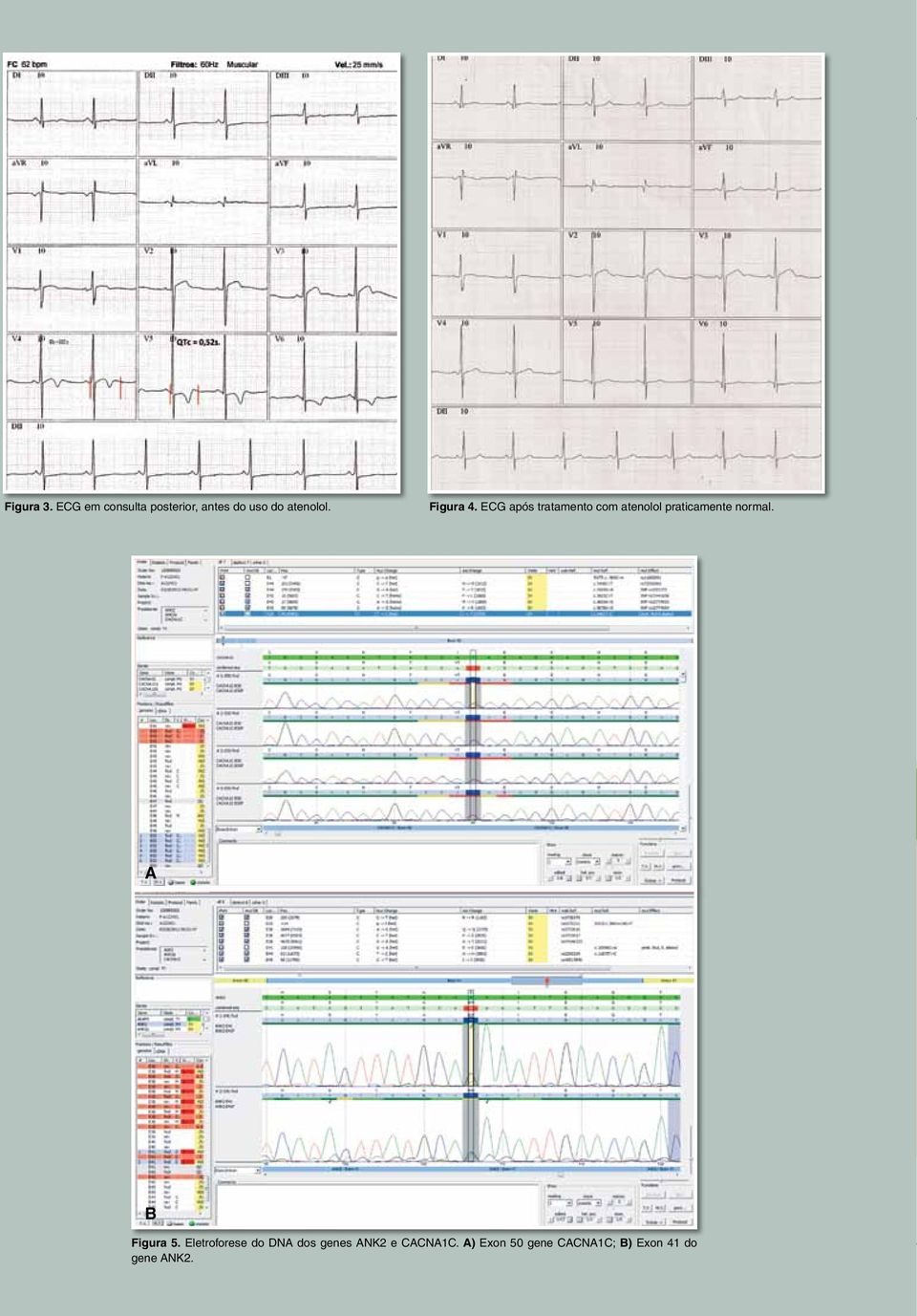 ECG após tratamento com atenolol praticamente normal. A B Figura 5.