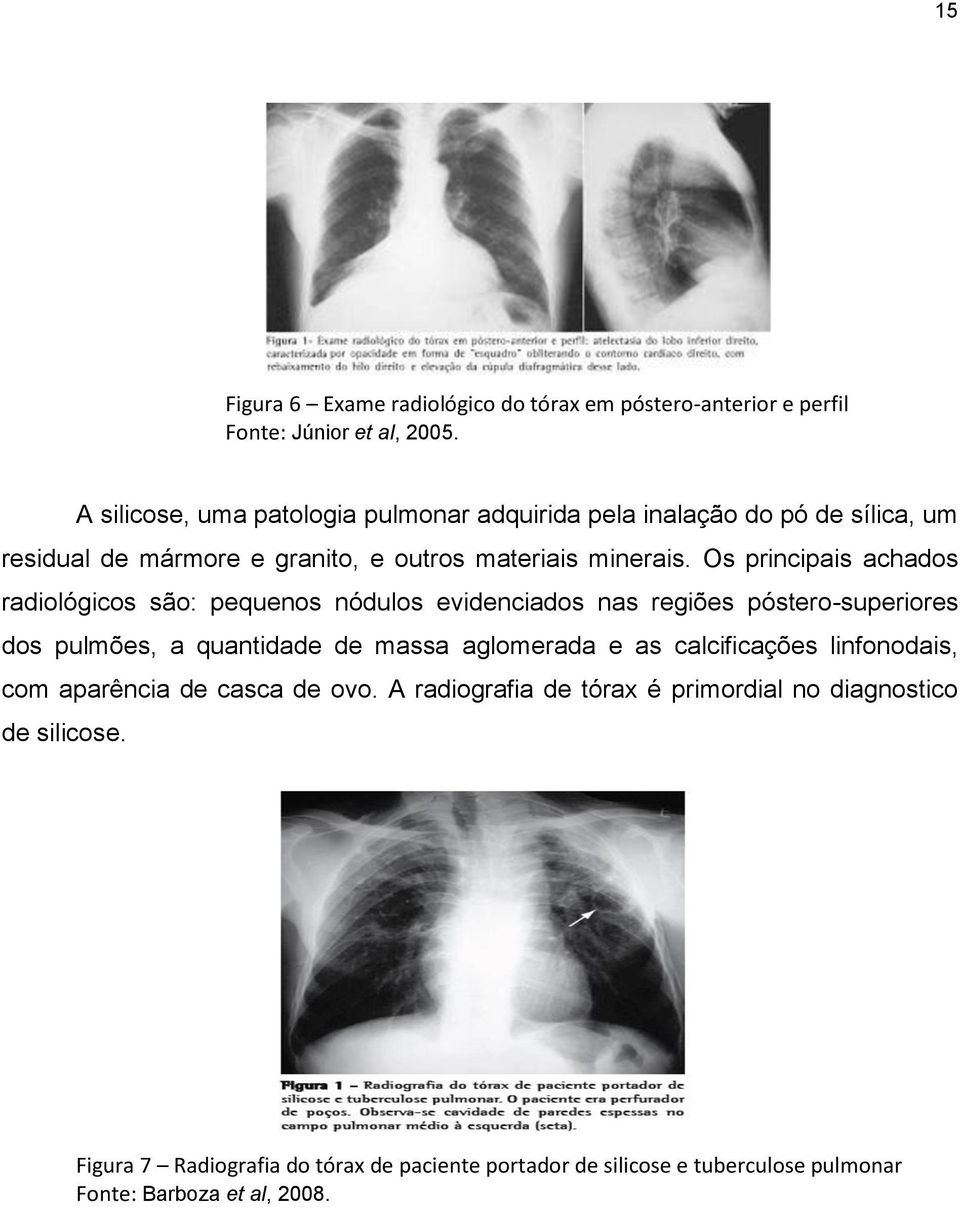 Os principais achados radiológicos são: pequenos nódulos evidenciados nas regiões póstero-superiores dos pulmões, a quantidade de massa aglomerada e as